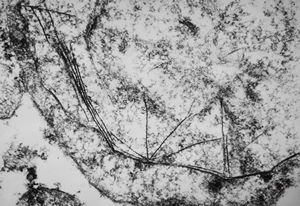 F,76y. | intranuclear needle-like structures - rhabdomyoma,tongue F,76y. | intranuclear needle-like structures - rhabdomyoma,tongue